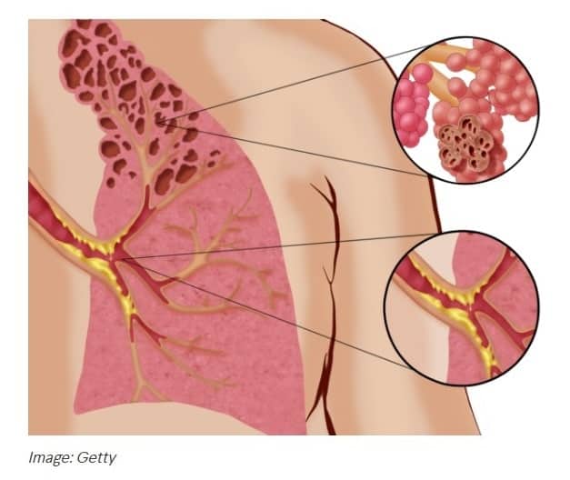 E-cigarettes linked to Popcorn Lung
